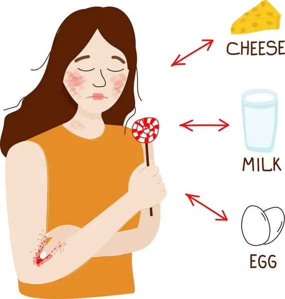 Süt Alerjisinde Deri Iltihabı Olan Kız Neğin Süt Proteinine Yumurtaya — Stok Vektör