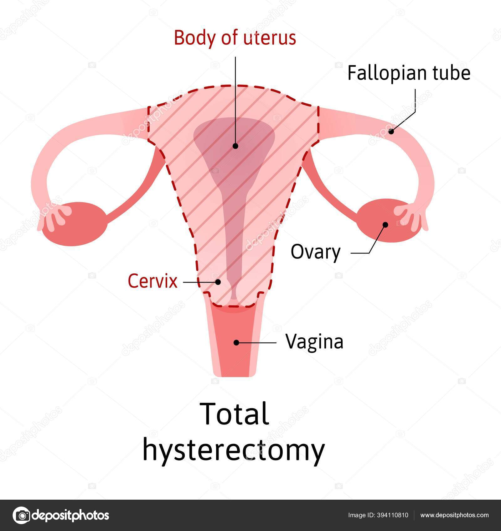 Hysterectomy, surgical removal of the uterus. Medical vector illustration  shows one type of hysterectomy total, when removes body of uterus and  Cervix. Vagina and ovary stay safe Stock Vector Image by ©Betty1994 #