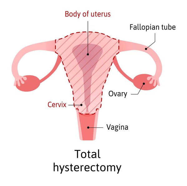 Hysterectomy, surgical removal of the uterus. Medical vector illustration shows one type of hysterectomy total, when removes body of uterus and Cervix. Vagina and ovary stay safe