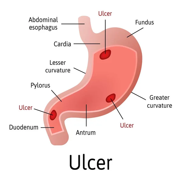 Úlcera péptica del estómago, anatomía microscópica de colores sobre un fondo blanco. Ilustración de vectores médicos con todas las partes internas están marcadas con líneas . — Vector de stock