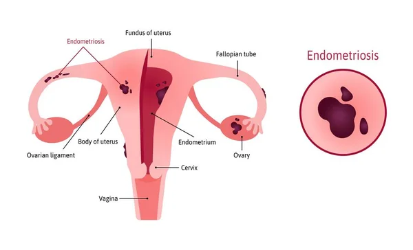 Endometriosis of uterus involves ovaries, fallopian tubes and cervix. Endometriosis close up. Womb witj vagina and ovary. Marked with lines. Vector medical illustration. — Stockový vektor