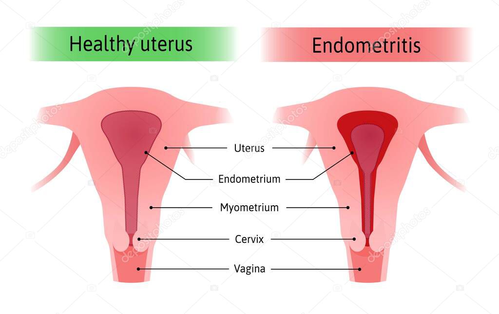 Endometritis or inflammation of the inner lining of the uterus endometrium. Normal healthy uterus and inflammed endometrium. Mediacal vector illustration marked with lines