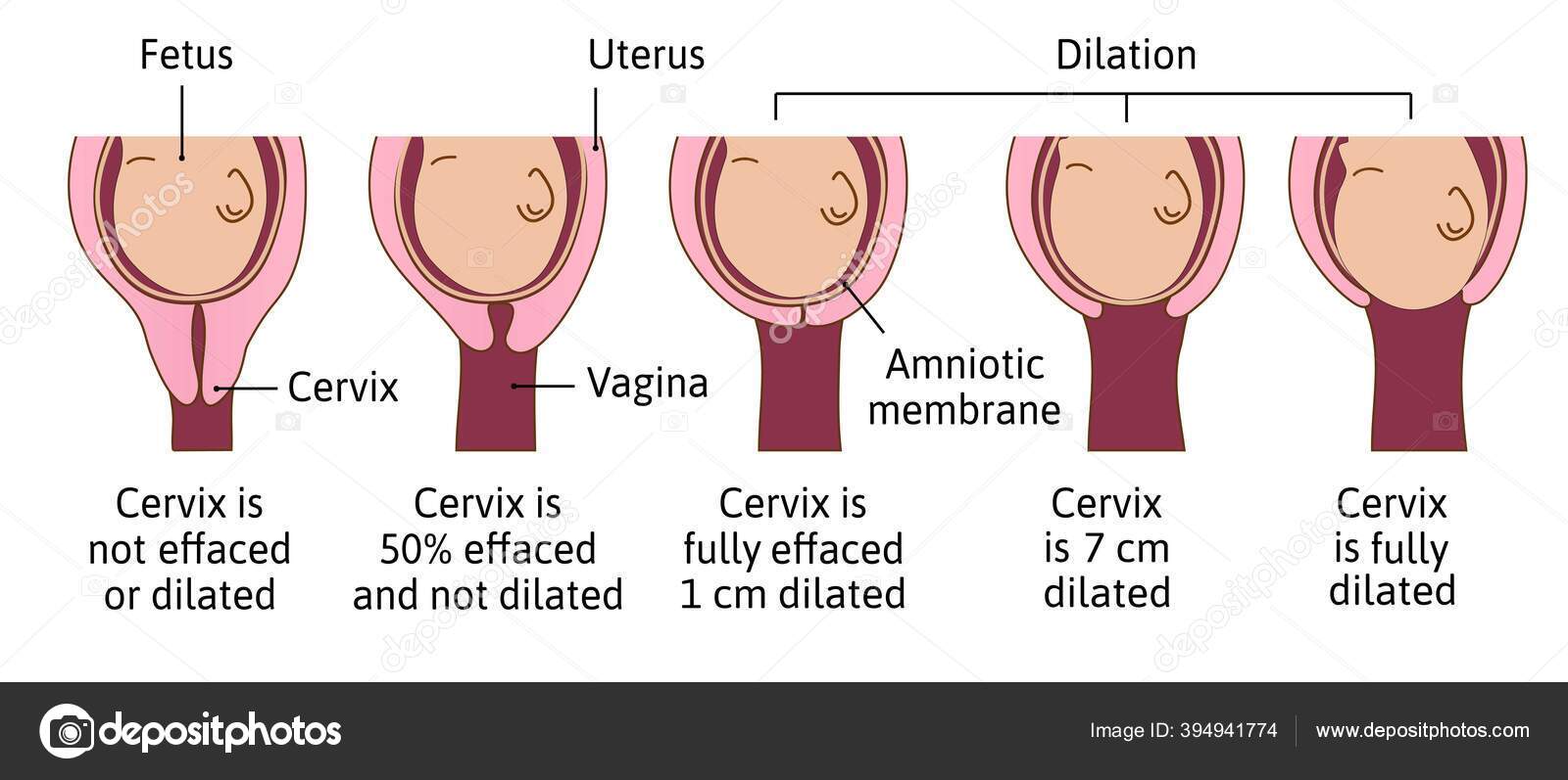 Cervical effacement and dilation during labor or delivery. Cervix