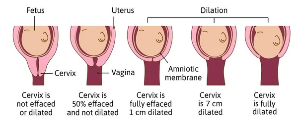 Effetto cervicale e dilatazione durante il travaglio o il parto. La cervice passa da non eliminata e dilatata a completamente eliminata e totalmente dilatata. Illustrazione medica vettoriale. — Vettoriale Stock