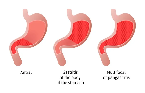Ubicación de la gastritis, una inflamación del revestimiento del estómago. Tres tipos Antral, del cuerpo y pangastritis. Ilustración médica vectorial marcada con líneas. Todas las partes del estómago — Vector de stock