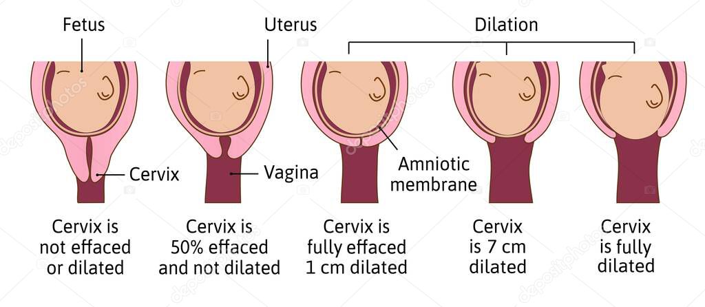 Cervical effacement and dilation during labor or delivery. Cervix changes from not effaced and dilated to fully effaced and totally dilated. Vector medical illustration.