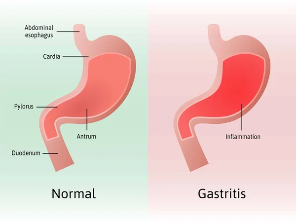 Gastritis, una inflamación, irritación o erosión del revestimiento del estómago. Ilustración médica vectorial marcada con líneas. Todas las partes del estómago. Órgano normal y con gasrtitis — Vector de stock