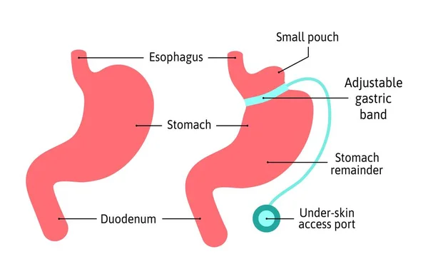 Banda gástrica diagrama de ilustración médica anatómica. La cirugía divide el estómago en dos partes con banda. Anatomía estomacal humana aislada sobre fondo blanco. Estómago y sistema de órganos digestivos, vector — Vector de stock