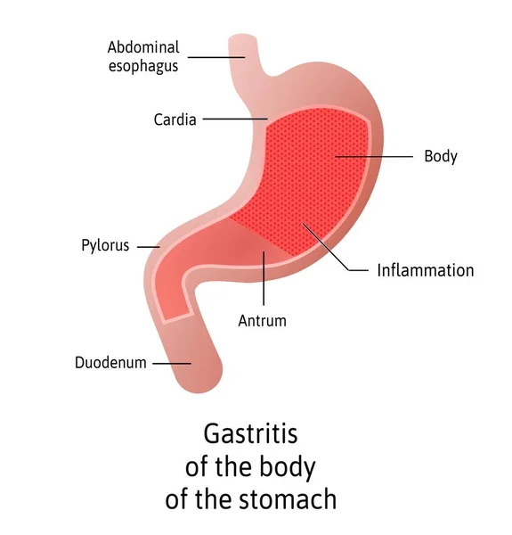 Ubicación de Gastritis, cuerpo de la misma, una inflamación del revestimiento del estómago. Tres tipos Antral, del cuerpo y pangastritis. Ilustración médica vectorial marcada con líneas. Todas las partes del estómago — Vector de stock