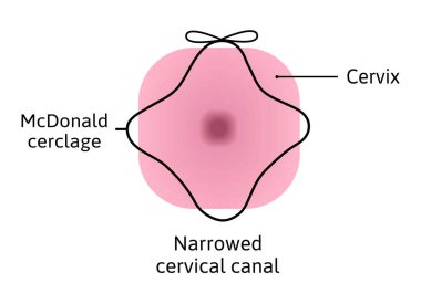 McDonald cerclage tightening of cervix opening during pregnancy. Anatomy of cervical canal. cervix weakness and black cerclage on it. vector illustration marked with lines. Medical drawing isolated clipart