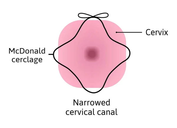 Mcdonald Cerclage Tightening Cervix Opening Pregnancy Anatomy Cervical Canal Cervix — Stock Vector