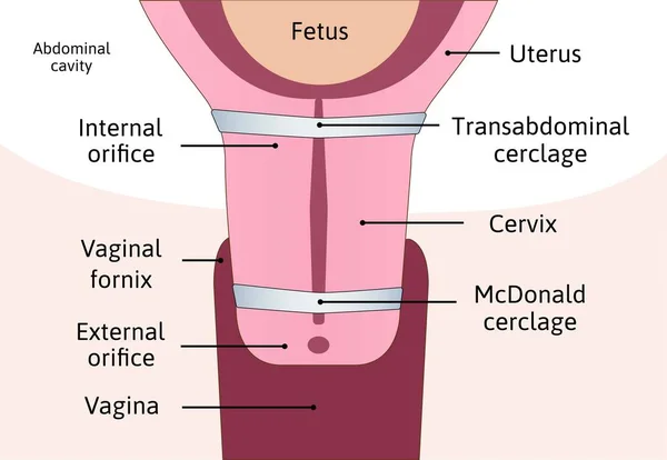 Transabdominal Cerclage Tightening Cervix Opening Pregnancy Anatomy Cervix Mcdonald Cerclage — Stock Vector