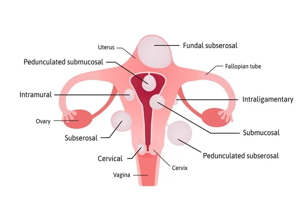 Děložní Fibroidy Nerakovinné Výrůstky Dělohy Různá Místa Děloze Subserosal Submukosal — Stockový vektor