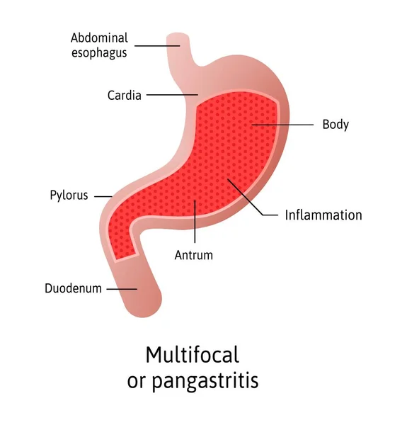 胃炎部位 多病灶 胃壁发炎 三种类型的胃肠道 身体和胃炎 用线条标出的医学矢量图解 胃的各个部位 — 图库矢量图片