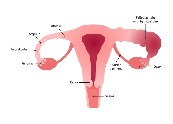 水仙花 输卵管因受伤或感染而被水液堵塞 Uterus Healthy Inflamed Tube 标有线条的病媒医学说明 — 图库矢量图片