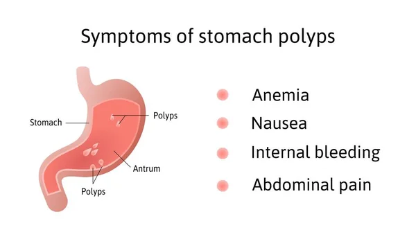 Symtom på gastriska polyper. fotokulerad och platt polyp. Antrum. Anemi, illamående. Medicinsk vektor illustration märkt med linjer — Stock vektor