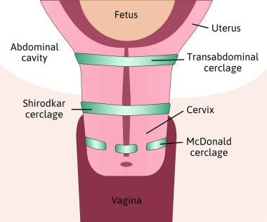 Servikal serklaj ya da servikal dikişin üç çeşidi var. Servikal zayıflık tedavisi görüyor. Transabdominal, Shirodkar ve McDonald Serclage. Rahimde fetüs, rahim. Renkli tıbbi vektör çizimi