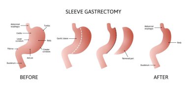 Dikey Kollu Gastrectomy. Beyaz arka planda izole edilmiş insan mide anatomisi. Mide hacminde azalma. Çizgilerle işaretlenmiş vektör illüstrasyonu.