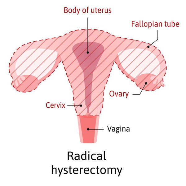 Hysterectomy, surgical removal of the uterus. Medical vector illustration shows one type of hysterectomy radical, when removes body of uterus, Cervix and ovary with fallopian tubes. Vagina stay safe