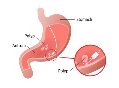 Mide poliplerinin çıkarılması, midenin içindeki hücre kütleleri. Düz tabanlı bir polip. Antrum. Tıbbi vektör çizgileri ile işaretlenmiş.