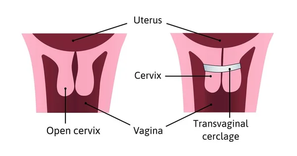 Cerclagem Cervical Aperto Abertura Cervical Durante Gravidez Problema Lesão Útero — Vetor de Stock