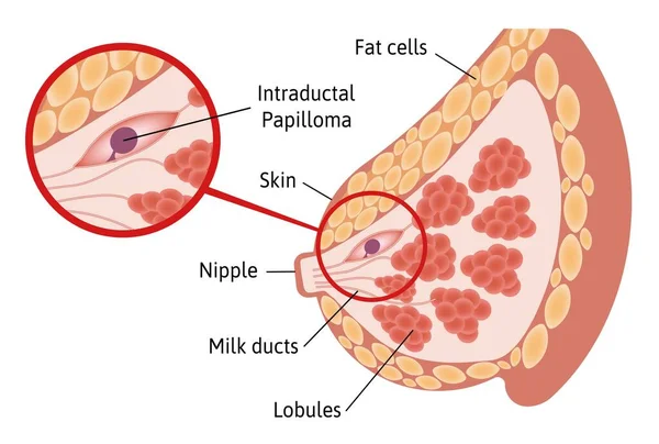 Papiloma Intraductal Solitário Tumor Localizado Dentro Dos Ductos Mamários Vista —  Vetores de Stock