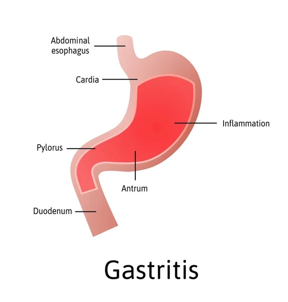 Gastritis, una inflamación, irritación o erosión del revestimiento del estómago. Ilustración médica vectorial marcada con líneas. Todas las partes del estómago — Vector de stock