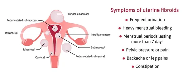 Děložní fibroidy a jejich symptomy. Seznam symptomů. Různá místa v děloze subserosal, submukosal, pedunculated, cervical. fibroidy jsou označeny čárami. Vektorová lékařská ilustrace — Stockový vektor