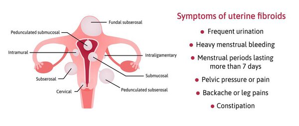 Uterine fibroids and its symptoms. List of symptoms. Different locations inside womb subserosal, submucosal, pedunculated, cervical. fibroids are marked with lines. Vector medical illustration