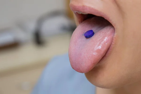 Tablet pengungkapan ungu untuk mengindikasikan plakat pada lidah seorang wanita Stok Lukisan  