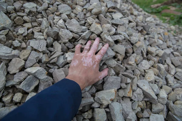 hand with skin pigmentation vitiligo stones touches