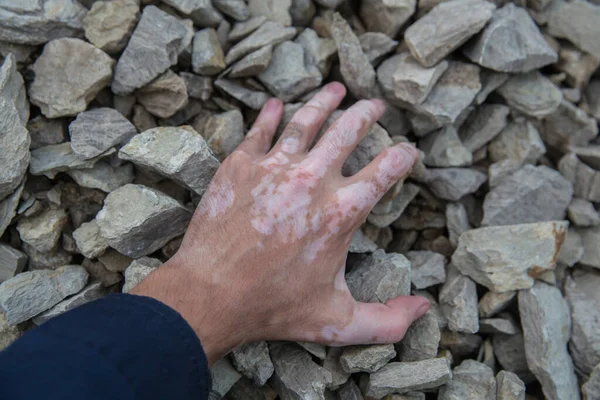 hand with skin pigmentation vitiligo stones touches