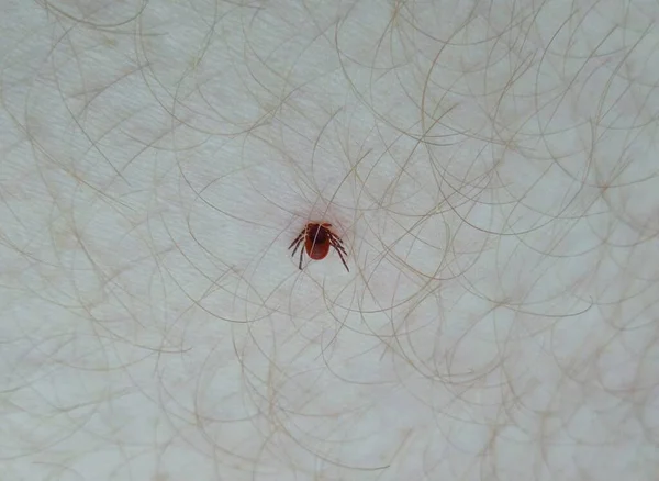 on a walk in the field, the tick stuck into the skin on the leg