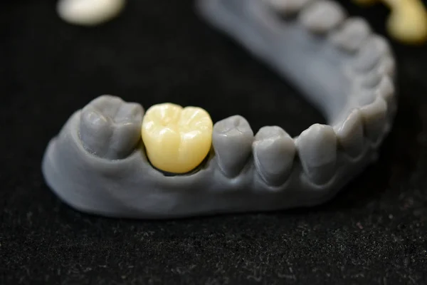 The lower jaw of a man, created on a 3d printer from a photopolymer material — Stock Photo, Image