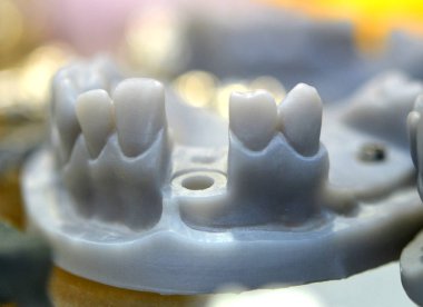Diş ve implant taç abutment için delikleri daraltılabilir çene model 3d bir yazıcıda yazdırılan