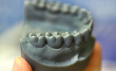 Bir adamın alt çenesi, bir fotopolimer materyalden 3d yazıcıda oluşturuldu