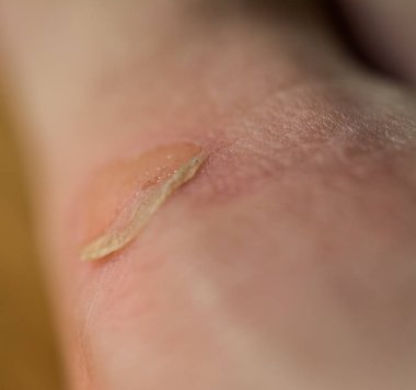 Nasır yakın çekim.