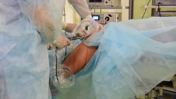 医生对膝关节进行了穿刺 并准备了微创手术设备 — 图库视频影像