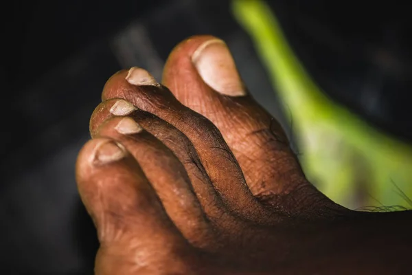 Koyu Tenli Adam Ayağı Yakın Plan Ayak Tırnağı Mantarı Siyah — Stok fotoğraf