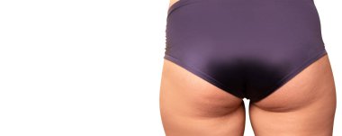 Selülitli kadın kalçaları ve beyaz arka planda gerilme izleri