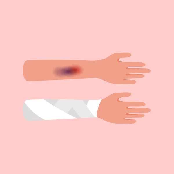 Severe Injury Bruise Arm Elastic Bandage Bandage Person Hand — Stock Vector