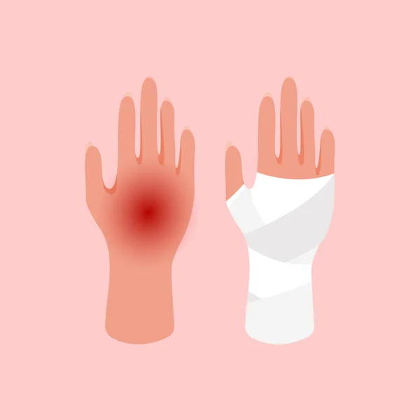 Τραυματισμένο Χέρι Του Κοριτσιού Δεμένο Λευκό Επίδεσμο Σπασμένο Κομμένο Τραυματισμένο — Διανυσματικό Αρχείο