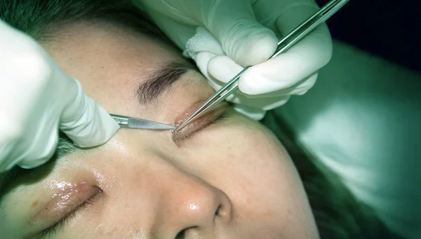 close up surgery eyelid process in beauty and medical industry