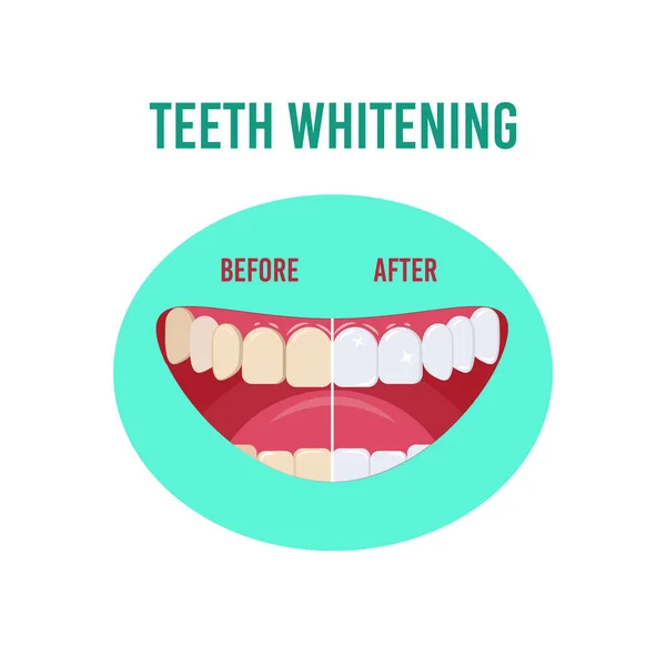 Antes e depois do clareamento dos dentes. Ilustração vetorial isolada sobre fundo branco —  Vetores de Stock