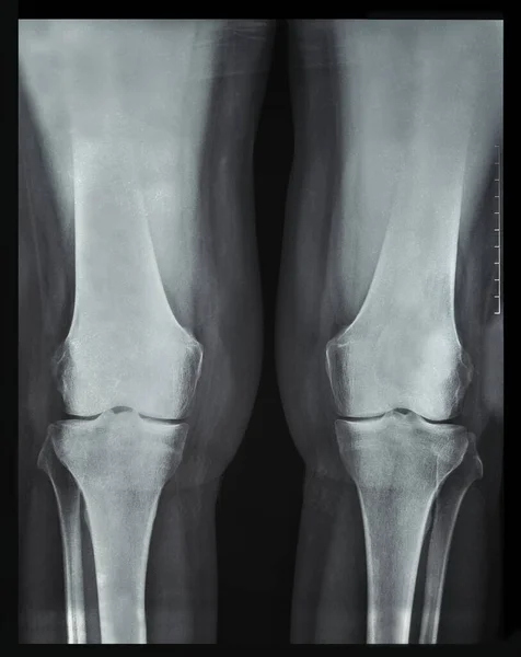 X-ray rheumatic diseases and knee Rheumatoid Arthritis two legs