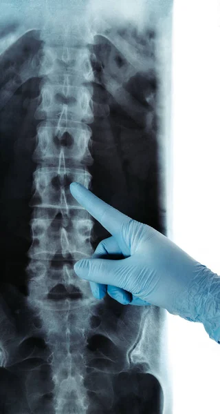 X-ray of lumbar spine radiology RTG blue glove pointed