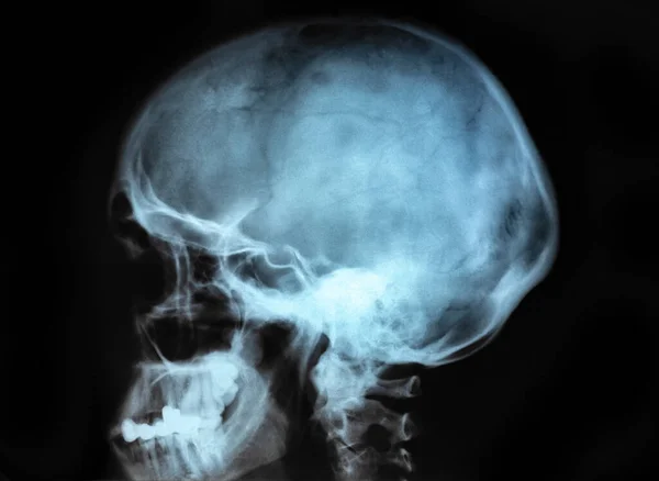 Human skull X-ray image isolated on black