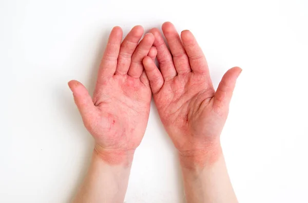 Jarige Kind Rood Gezwollen Gebarsten Atopische Dermatitis Handen Veroorzaakt Door — Stockfoto
