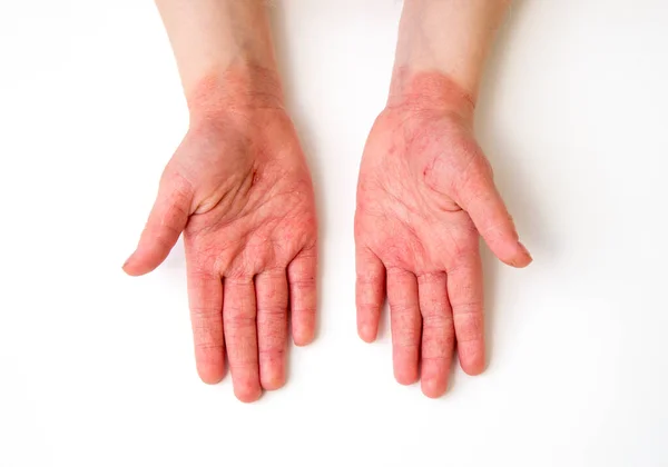 Year Old Child Red Swollen Cracked Atopic Dermatitis Hands Caused — Stock Photo, Image