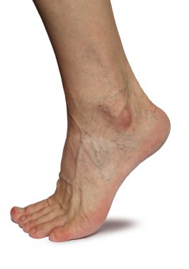 Erkek bacağında dışbükey damarlar ve örümcek damarları